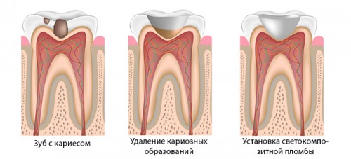 этапы-установки-пломбы-на-зуб